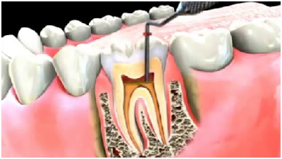 Best Root Canal Treatment in Jaipur