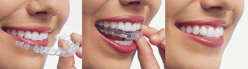 Invisible Aligners Treatment in Jaipur