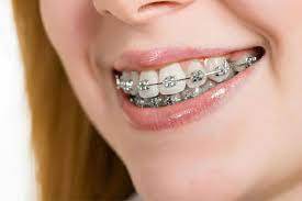 Best Braces Treatment in Jaipur