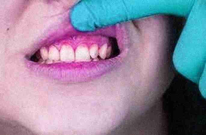 Best Clinic for Gums Bleeding in Jaipur